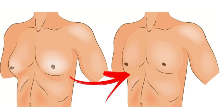 Pune’s Best Kept Secret: Effective Gynecomastia Treatment