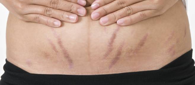 Smooth Skin Ahead: Tips and Tricks for Reducing Stretch Marks