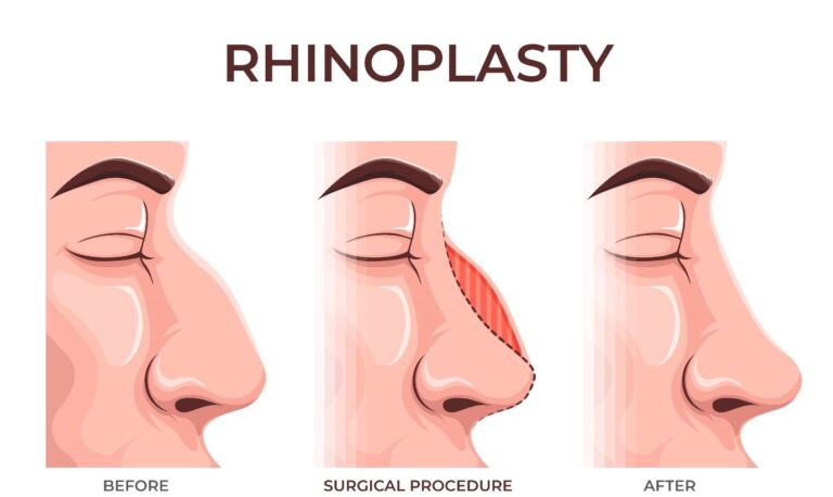 Rhinoplasty Surgery